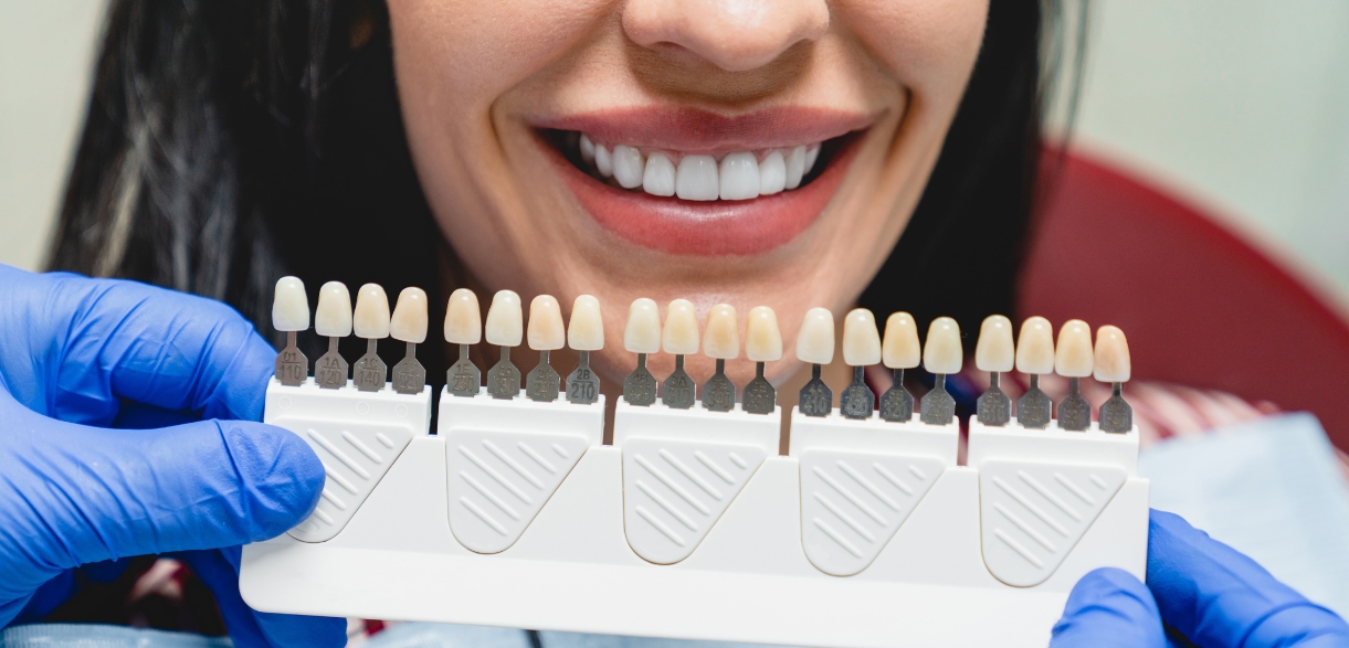 are you a good candidate for veneers