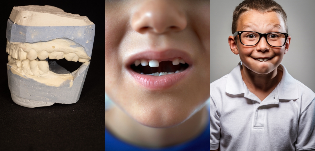what dental issues can clear aligners fix