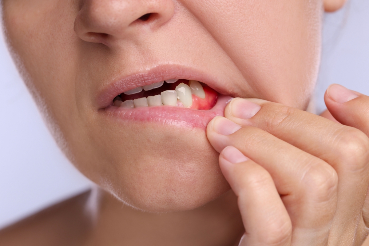 gum-disease-treatment-in-burke