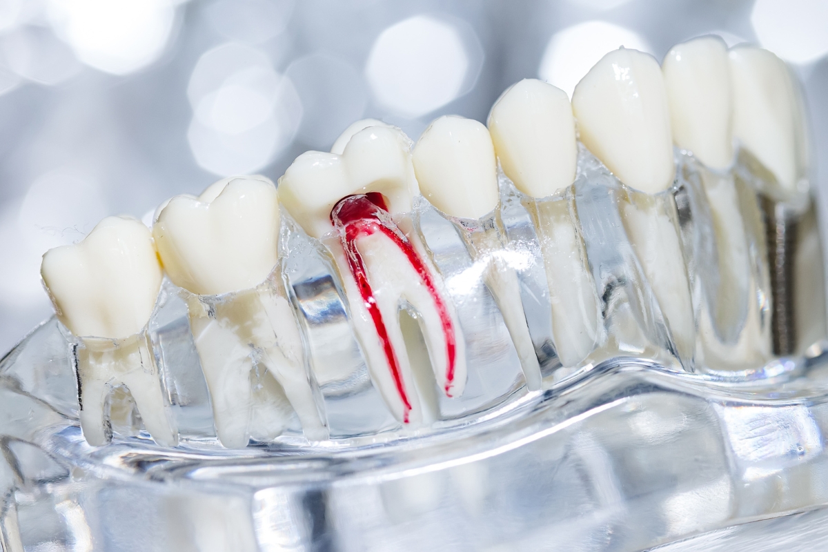 root-canal-treatment-in-burke